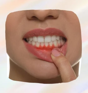 Ako liečiť afty v ústach alebo na jazyku?